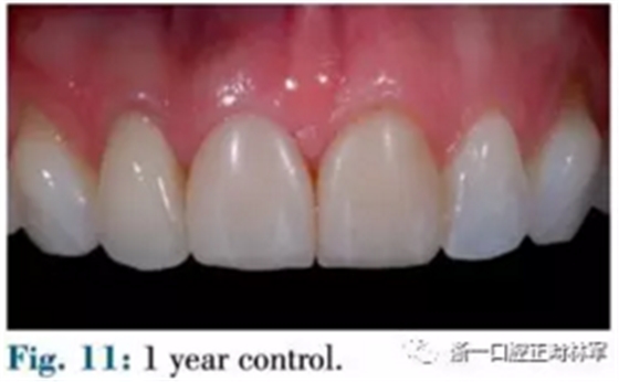 文獻(xiàn)優(yōu)秀正畸病例賞析--正畸牙周聯(lián)合治療方法病例介紹 文獻(xiàn)優(yōu)秀正畸病例賞析--正畸牙周聯(lián)合治療方法病例介紹