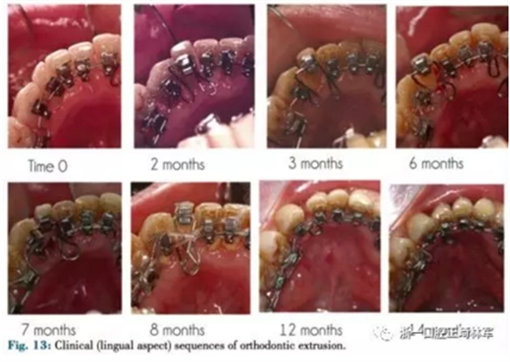 文獻(xiàn)優(yōu)秀正畸病例賞析--正畸牙周聯(lián)合治療方法病例介紹 文獻(xiàn)優(yōu)秀正畸病例賞析--正畸牙周聯(lián)合治療方法病例介紹