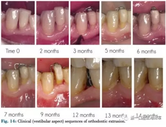 文獻(xiàn)優(yōu)秀正畸病例賞析--正畸牙周聯(lián)合治療方法病例介紹 文獻(xiàn)優(yōu)秀正畸病例賞析--正畸牙周聯(lián)合治療方法病例介紹
