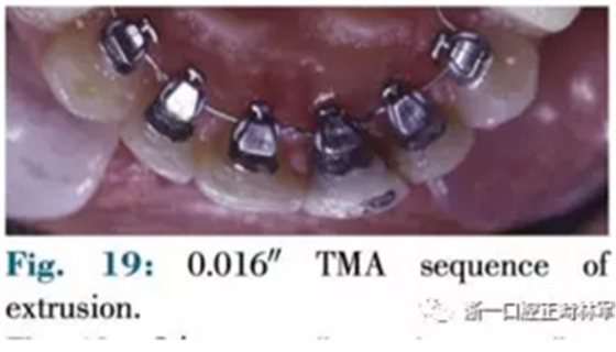 文獻(xiàn)優(yōu)秀正畸病例賞析--正畸牙周聯(lián)合治療方法病例介紹 文獻(xiàn)優(yōu)秀正畸病例賞析--正畸牙周聯(lián)合治療方法病例介紹