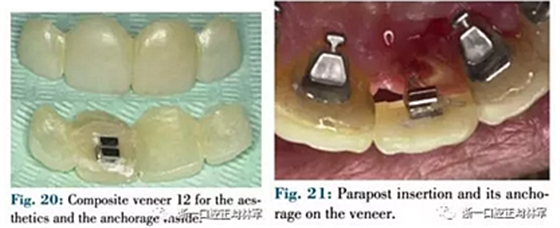 文獻(xiàn)優(yōu)秀正畸病例賞析--正畸牙周聯(lián)合治療方法病例介紹 文獻(xiàn)優(yōu)秀正畸病例賞析--正畸牙周聯(lián)合治療方法病例介紹