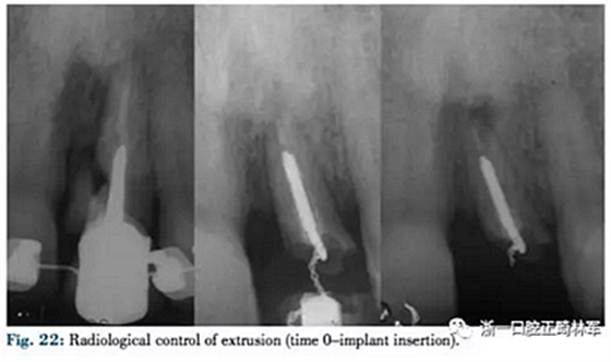 文獻(xiàn)優(yōu)秀正畸病例賞析--正畸牙周聯(lián)合治療方法病例介紹 文獻(xiàn)優(yōu)秀正畸病例賞析--正畸牙周聯(lián)合治療方法病例介紹