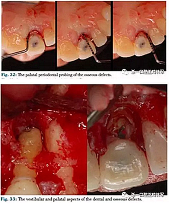 文獻(xiàn)優(yōu)秀正畸病例賞析--正畸牙周聯(lián)合治療方法病例介紹 文獻(xiàn)優(yōu)秀正畸病例賞析--正畸牙周聯(lián)合治療方法病例介紹