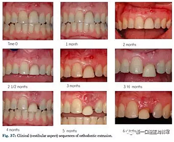 文獻(xiàn)優(yōu)秀正畸病例賞析--正畸牙周聯(lián)合治療方法病例介紹 文獻(xiàn)優(yōu)秀正畸病例賞析--正畸牙周聯(lián)合治療方法病例介紹