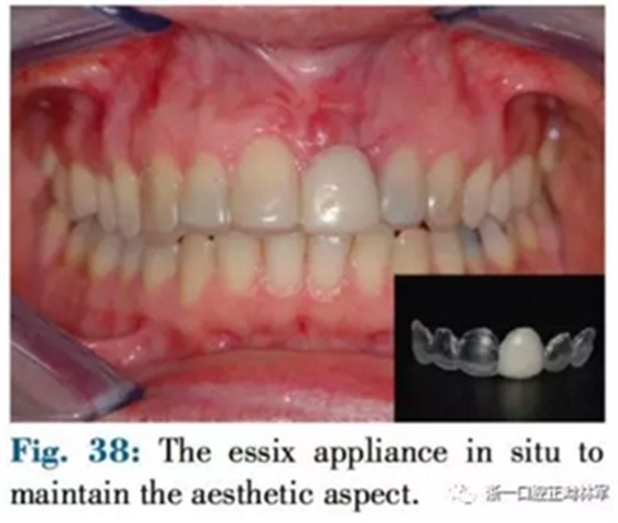 文獻(xiàn)優(yōu)秀正畸病例賞析--正畸牙周聯(lián)合治療方法病例介紹 文獻(xiàn)優(yōu)秀正畸病例賞析--正畸牙周聯(lián)合治療方法病例介紹
