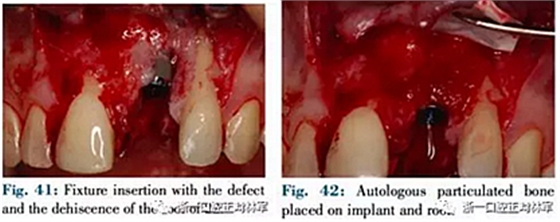文獻(xiàn)優(yōu)秀正畸病例賞析--正畸牙周聯(lián)合治療方法病例介紹 文獻(xiàn)優(yōu)秀正畸病例賞析--正畸牙周聯(lián)合治療方法病例介紹