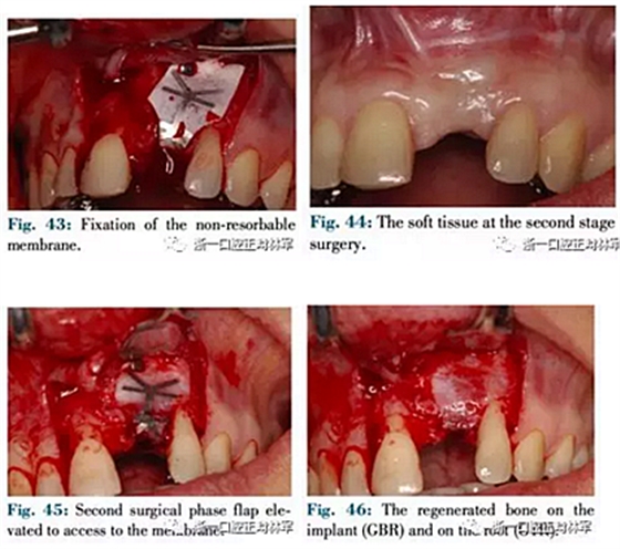 文獻(xiàn)優(yōu)秀正畸病例賞析--正畸牙周聯(lián)合治療方法病例介紹 文獻(xiàn)優(yōu)秀正畸病例賞析--正畸牙周聯(lián)合治療方法病例介紹