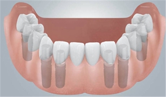 無牙頜種植修復的檢查與設計——施斌教授 無牙頜種植修復的檢查與設計——施斌教授