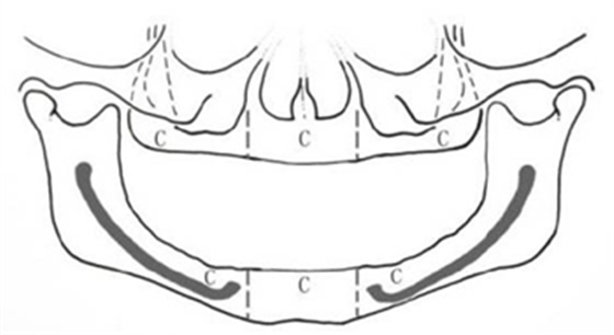 無牙頜種植修復的檢查與設計——施斌教授 無牙頜種植修復的檢查與設計——施斌教授