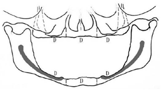 無牙頜種植修復的檢查與設計——施斌教授 無牙頜種植修復的檢查與設計——施斌教授