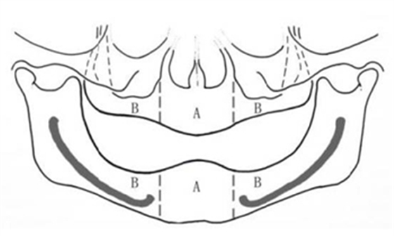 無牙頜種植修復的檢查與設計——施斌教授 無牙頜種植修復的檢查與設計——施斌教授