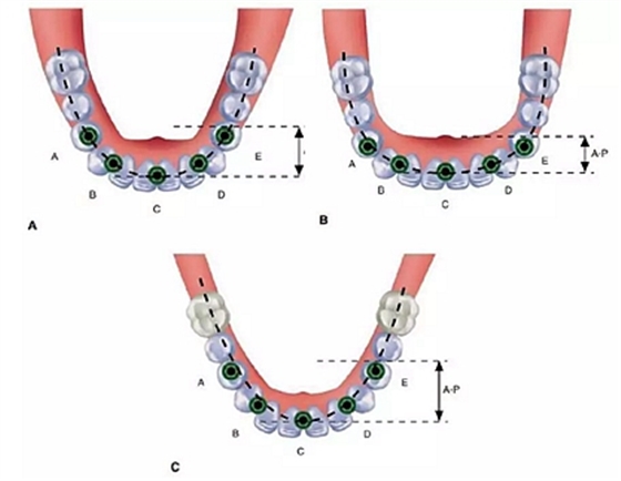 無牙頜種植修復的檢查與設計——施斌教授 無牙頜種植修復的檢查與設計——施斌教授