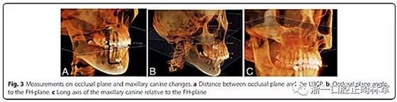 正畸文獻(xiàn)閱讀--用舌側(cè)滑動(dòng)牽引系統(tǒng)控制前牙區(qū)段:初步的CBCT研究 正畸文獻(xiàn)閱讀--用舌側(cè)滑動(dòng)牽引系統(tǒng)控制前牙區(qū)段:初步的CBCT研究