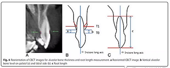 正畸文獻(xiàn)閱讀--用舌側(cè)滑動(dòng)牽引系統(tǒng)控制前牙區(qū)段:初步的CBCT研究 正畸文獻(xiàn)閱讀--用舌側(cè)滑動(dòng)牽引系統(tǒng)控制前牙區(qū)段:初步的CBCT研究