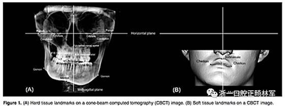 正畸文獻(xiàn)閱讀--III類面部不對(duì)稱患者在正畸掩飾性治療、單頜手術(shù)、雙頜手術(shù)后的唇線改變：初步研究