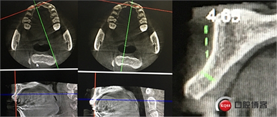 上前牙骨量不足種植+信封式植骨(梁光強) 上前牙骨量不足種植+信封式植骨(梁光強)