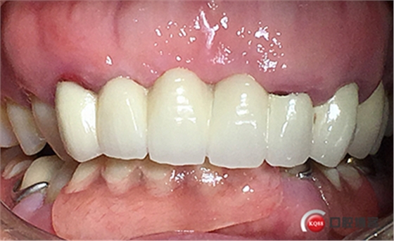 上前牙骨量不足種植+信封式植骨(梁光強) 上前牙骨量不足種植+信封式植骨(梁光強)