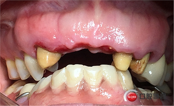 上前牙骨量不足種植+信封式植骨(梁光強) 上前牙骨量不足種植+信封式植骨(梁光強)