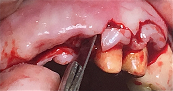 上前牙骨量不足種植+信封式植骨(梁光強) 上前牙骨量不足種植+信封式植骨(梁光強)