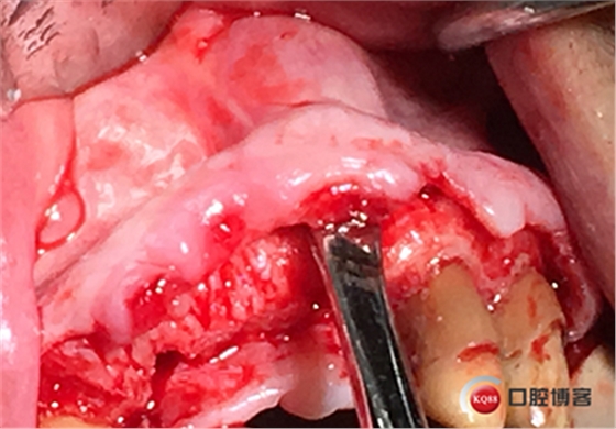 上前牙骨量不足種植+信封式植骨(梁光強) 上前牙骨量不足種植+信封式植骨(梁光強)