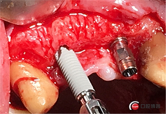 上前牙骨量不足種植+信封式植骨(梁光強) 上前牙骨量不足種植+信封式植骨(梁光強)