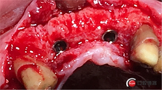 上前牙骨量不足種植+信封式植骨(梁光強) 上前牙骨量不足種植+信封式植骨(梁光強)