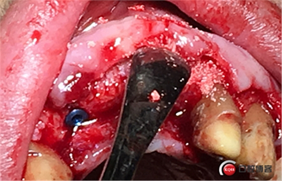 上前牙骨量不足種植+信封式植骨(梁光強) 上前牙骨量不足種植+信封式植骨(梁光強)