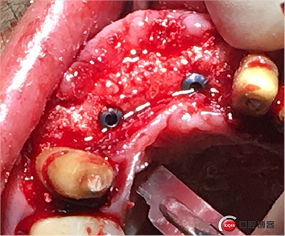 上前牙骨量不足種植+信封式植骨(梁光強) 上前牙骨量不足種植+信封式植骨(梁光強)