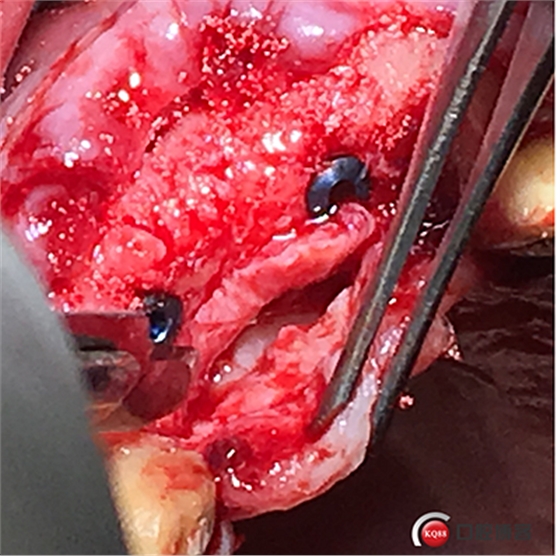 上前牙骨量不足種植+信封式植骨(梁光強) 上前牙骨量不足種植+信封式植骨(梁光強)