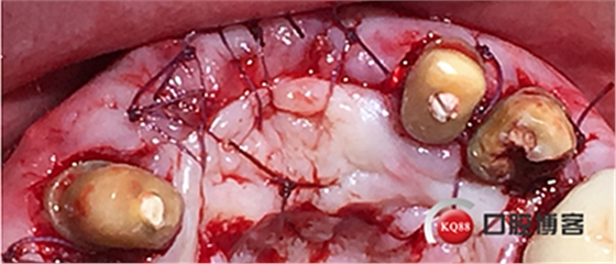 上前牙骨量不足種植+信封式植骨(梁光強) 上前牙骨量不足種植+信封式植骨(梁光強)