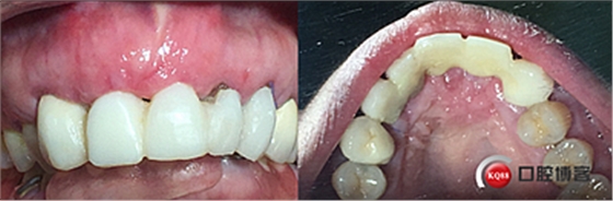 上前牙骨量不足種植+信封式植骨(梁光強) 上前牙骨量不足種植+信封式植骨(梁光強)