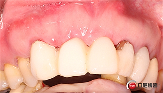 上前牙骨量不足種植+信封式植骨(梁光強) 上前牙骨量不足種植+信封式植骨(梁光強)