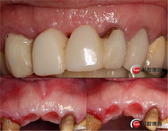 上前牙骨量不足種植+信封式植骨(梁光強) 上前牙骨量不足種植+信封式植骨(梁光強)
