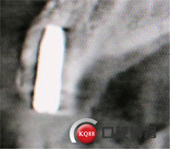 上前牙骨量不足種植+信封式植骨(梁光強) 上前牙骨量不足種植+信封式植骨(梁光強)