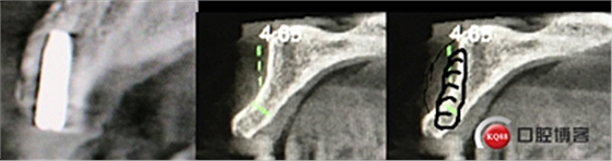 上前牙骨量不足種植+信封式植骨(梁光強) 上前牙骨量不足種植+信封式植骨(梁光強)