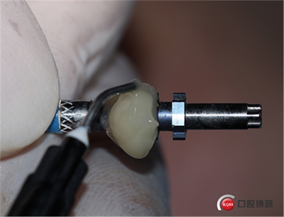 上前牙骨量不足種植+信封式植骨(梁光強) 上前牙骨量不足種植+信封式植骨(梁光強)