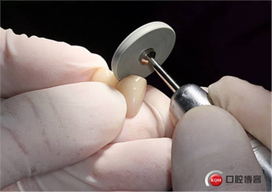 上前牙骨量不足種植+信封式植骨(梁光強) 上前牙骨量不足種植+信封式植骨(梁光強)