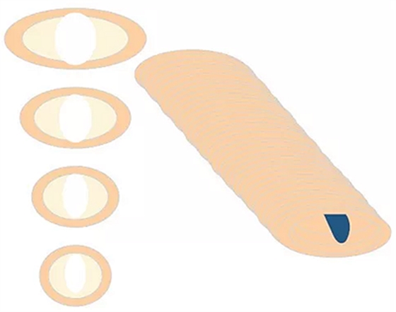知識分享:規(guī)范化根管治療的細(xì)節(jié)分析 知識分享:規(guī)范化根管治療的細(xì)節(jié)分析