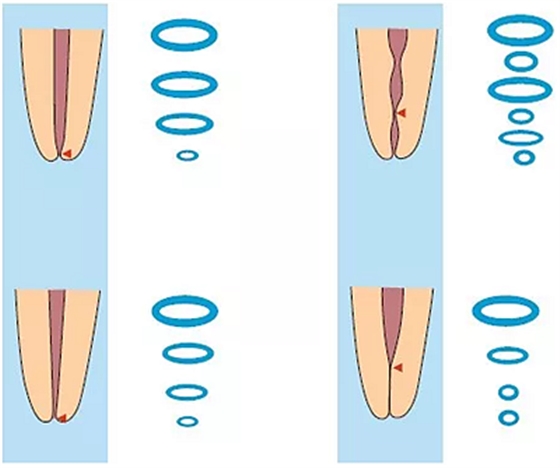 知識分享:規(guī)范化根管治療的細(xì)節(jié)分析 知識分享:規(guī)范化根管治療的細(xì)節(jié)分析