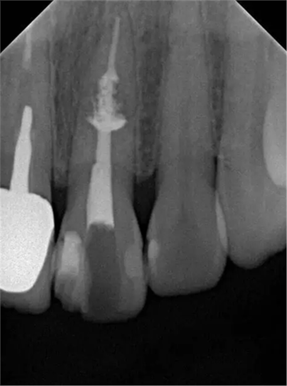 伴隨根管內(nèi)鈣化物形成牙根內(nèi)吸收治療1例 伴隨根管內(nèi)鈣化物形成牙根內(nèi)吸收治療1例
