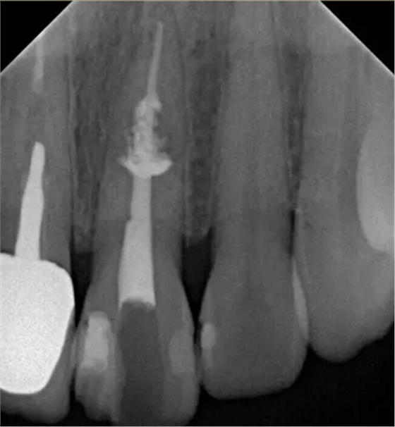伴隨根管內(nèi)鈣化物形成牙根內(nèi)吸收治療1例 伴隨根管內(nèi)鈣化物形成牙根內(nèi)吸收治療1例