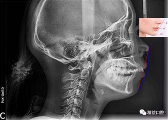 27歲嚴重齙牙，上下門牙牙根吸收嚴重，兩年矯正徹底蛻變，組建幸福家庭