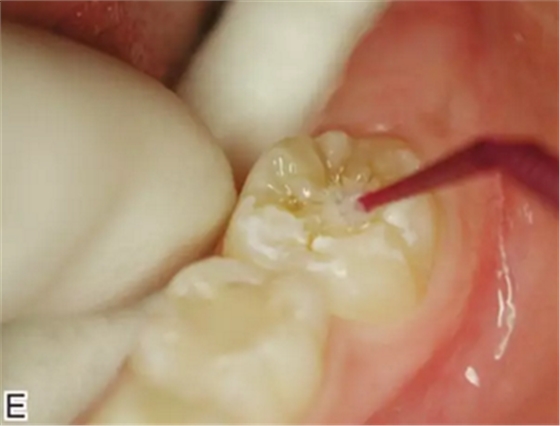 預防齲齒，口腔醫(yī)生能幫我做什么？局部用氟、窩溝封閉、預防性樹脂充填都是什么？