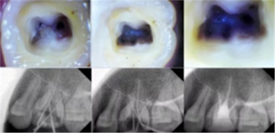 知識分享:根管治療的標(biāo)準(zhǔn)步驟 知識分享:根管治療的標(biāo)準(zhǔn)步驟