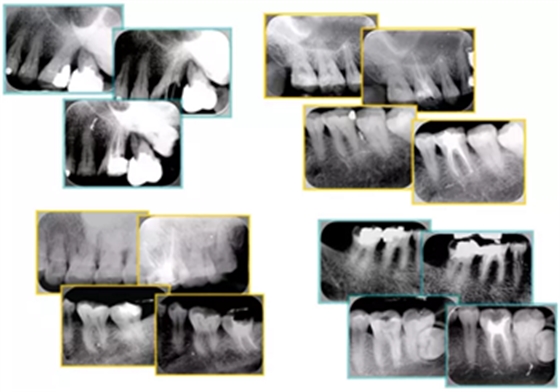 知識分享:根管治療的標(biāo)準(zhǔn)步驟 知識分享:根管治療的標(biāo)準(zhǔn)步驟