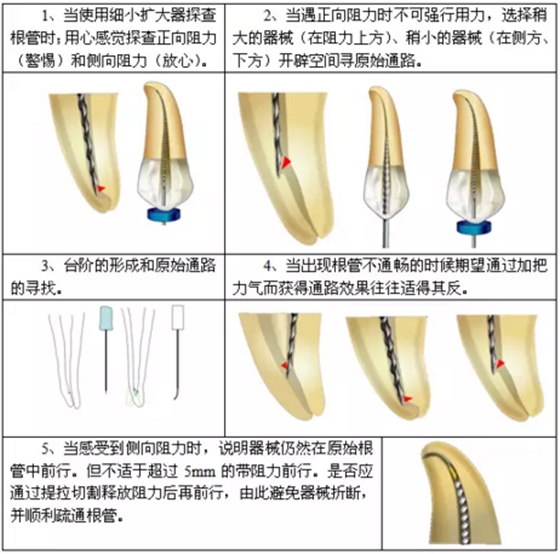 知識分享:根管治療的標(biāo)準(zhǔn)步驟 知識分享:根管治療的標(biāo)準(zhǔn)步驟