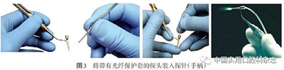 專題筆談 | 內(nèi)窺鏡在牙周診療中的應(yīng)用進(jìn)展 專題筆談 | 內(nèi)窺鏡在牙周診療中的應(yīng)用進(jìn)展