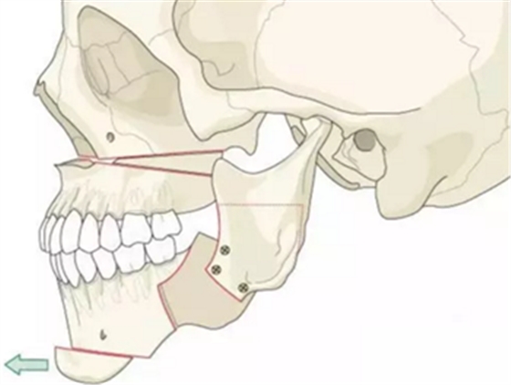正畸文獻賞析--正頜外科學的相關研究 正畸文獻賞析--正頜外科學的相關研究