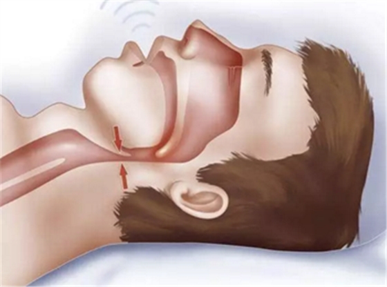 正畸文獻賞析--睡眠與正畸 正畸文獻賞析--睡眠與正畸