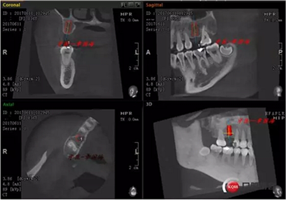 種植導(dǎo)板制作 種植導(dǎo)板制作